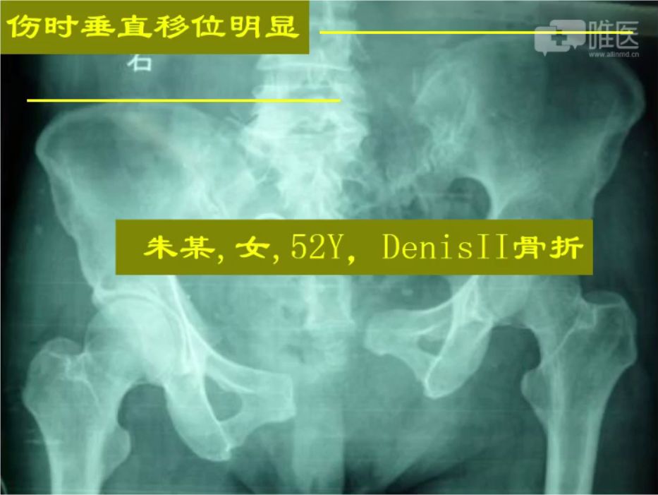 倒车移位讲解示范_倒车移位技巧图解